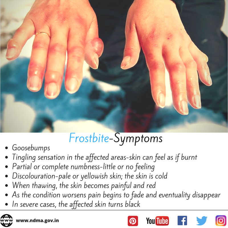 Goosebumps, tingling sensation in the affected areas, partial or complete numbness, discolouration, when thawing, the skin becomes painful and red, in severe cases, the affected skin turns black, as the condition worsens, pain begins to fade